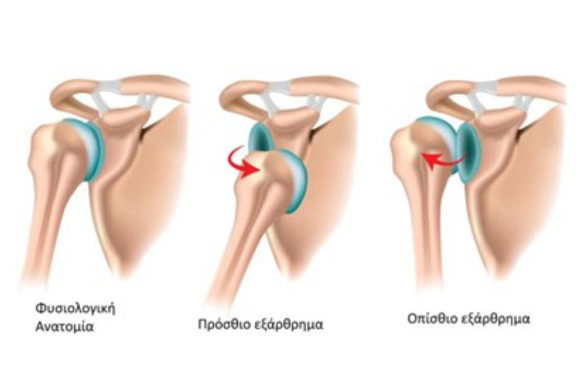 Εξάρθημα ώμου